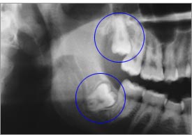 Dental X-Ray