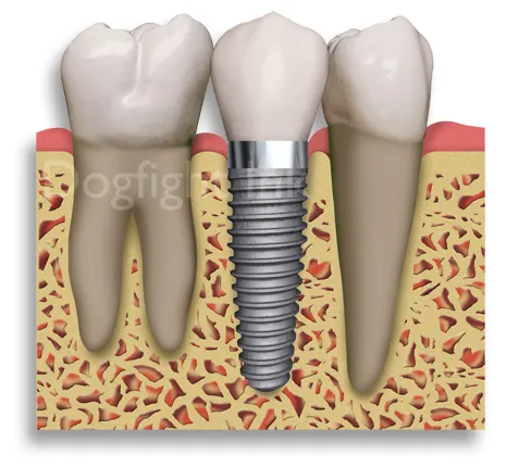 Dental Implants