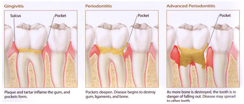 Gum Disease Diagram