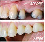 Fixed Bridges Before and After Image