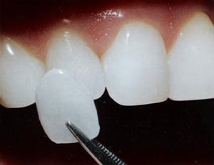 Veneers Shade match