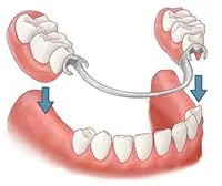 Partial Dentures Diagram