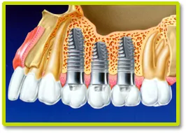 Dental Implants