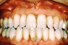 Mild Gum Disease
