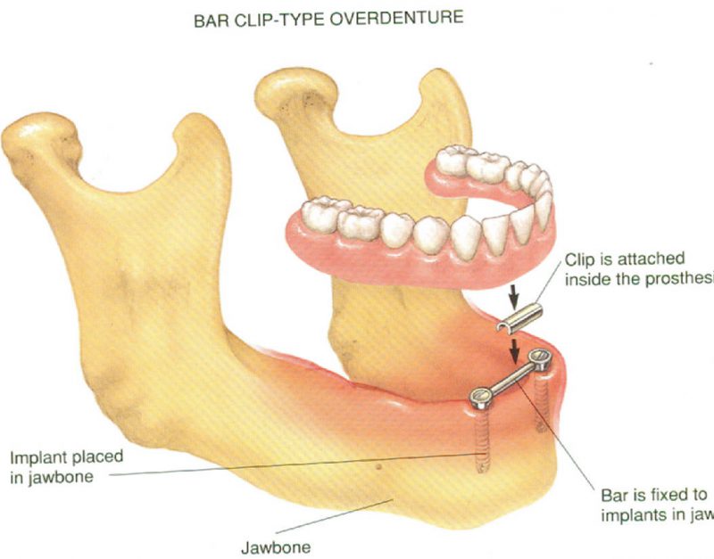Bar Clip type OverDenture Representation