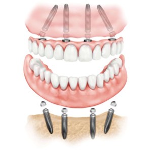 Full Mouth Over Dentures