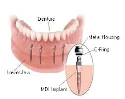 Dentures